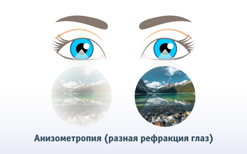 Анизометропия — разное зрение в глазах
